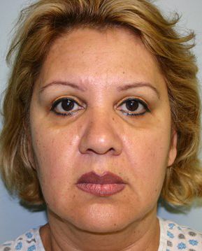 Face Lift Before & After