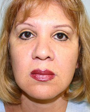 Face Lift Before & After