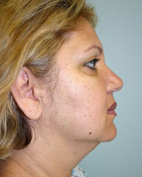 Face Lift Before & After