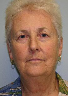 Face Lift Before & After