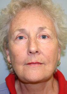 Face Lift Before & After