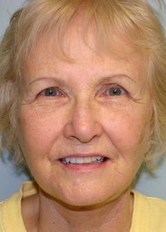 Face Lift Before & After