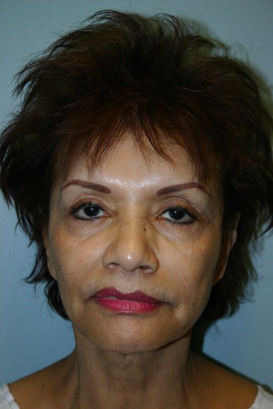 Face Lift Before & After