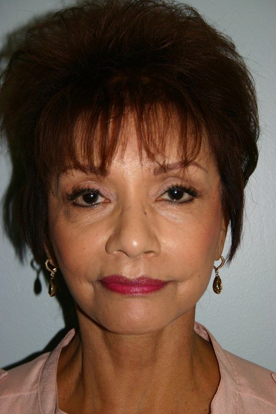 Face Lift Before & After