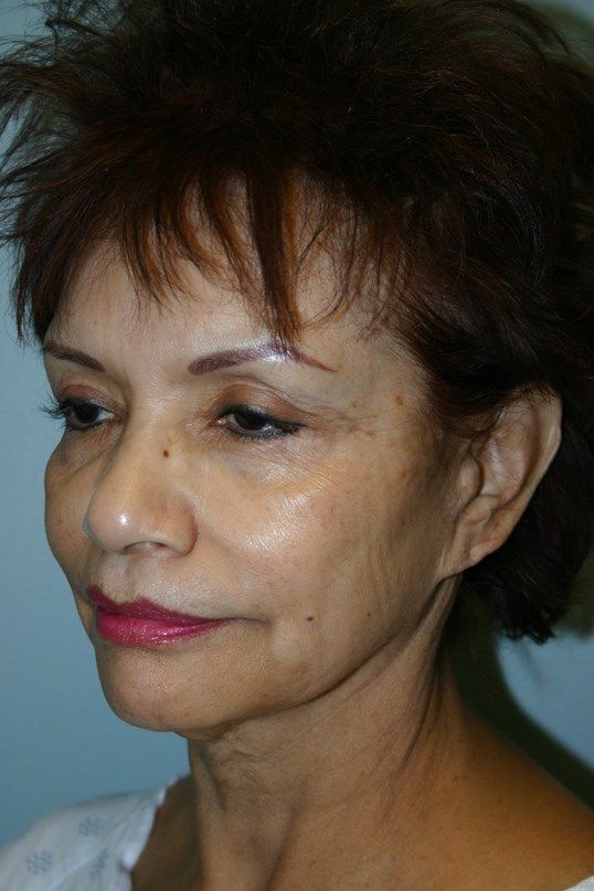 Face Lift Before & After