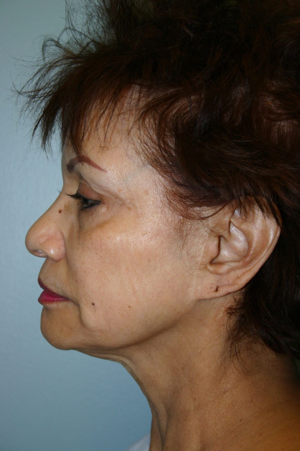 Face Lift Before & After