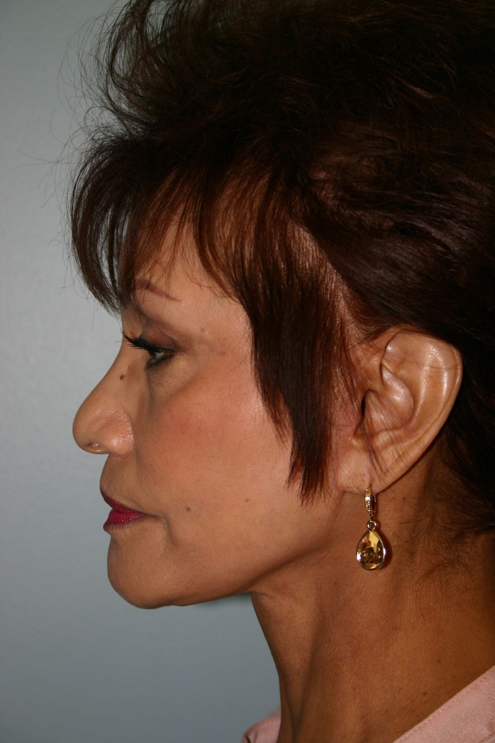 Face Lift Before & After