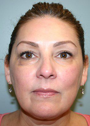 Face Lift Before & After