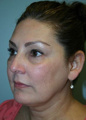 Face Lift Before & After