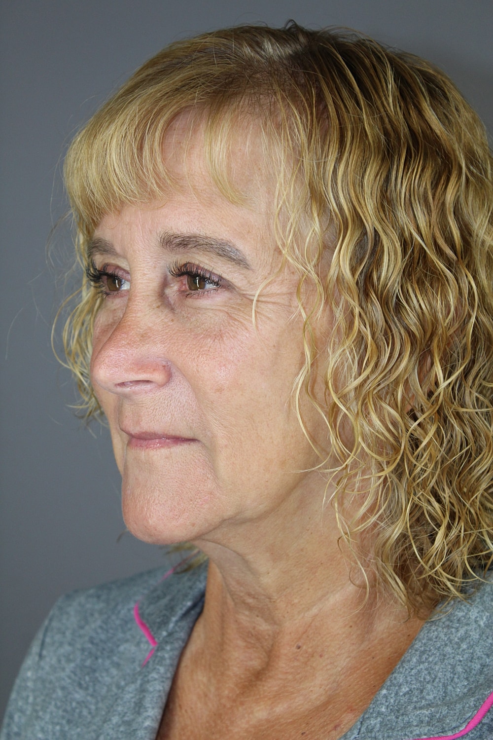 Face Lift Before & After