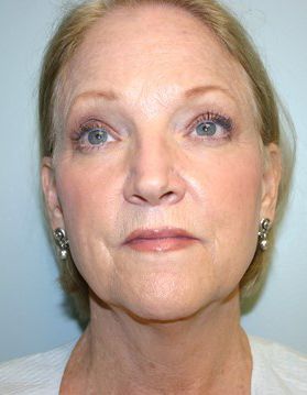 Face Lift Before & After