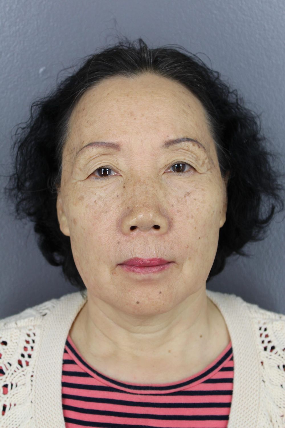 Face Lift Before & After