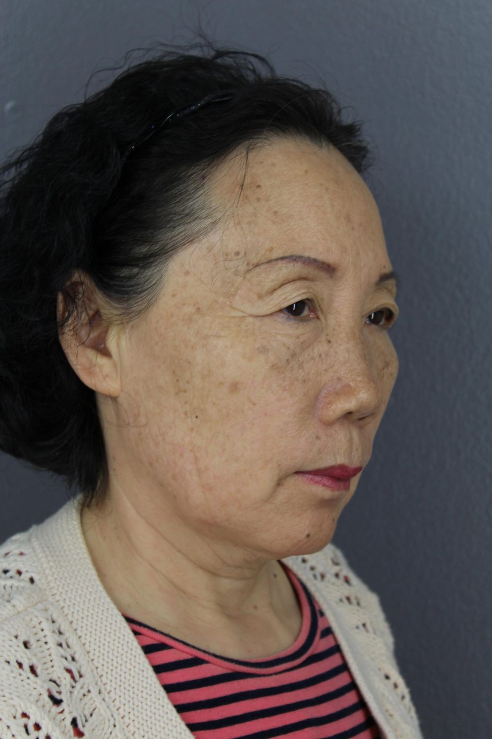 Face Lift Before & After