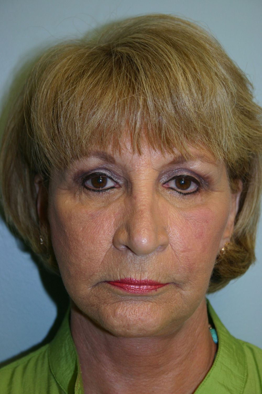 Face Lift Before & After