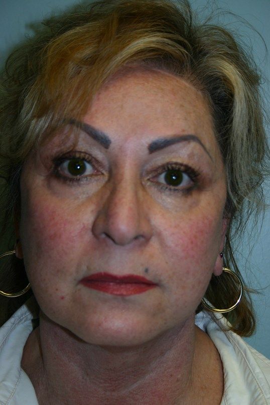 Face Lift Before & After