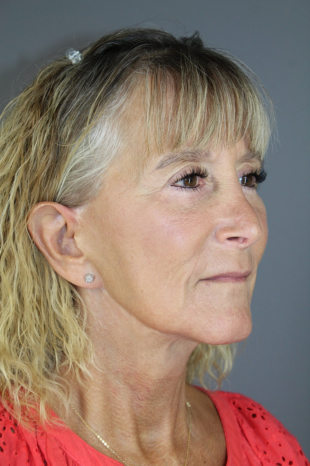 Face Lift Before & After