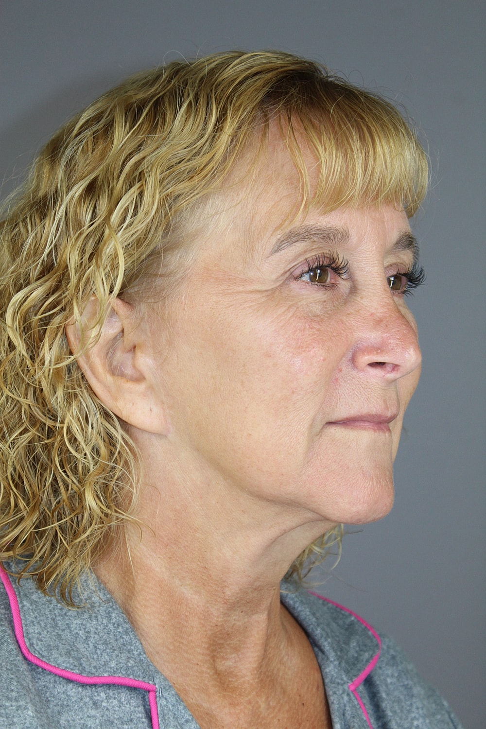 Face Lift Before & After