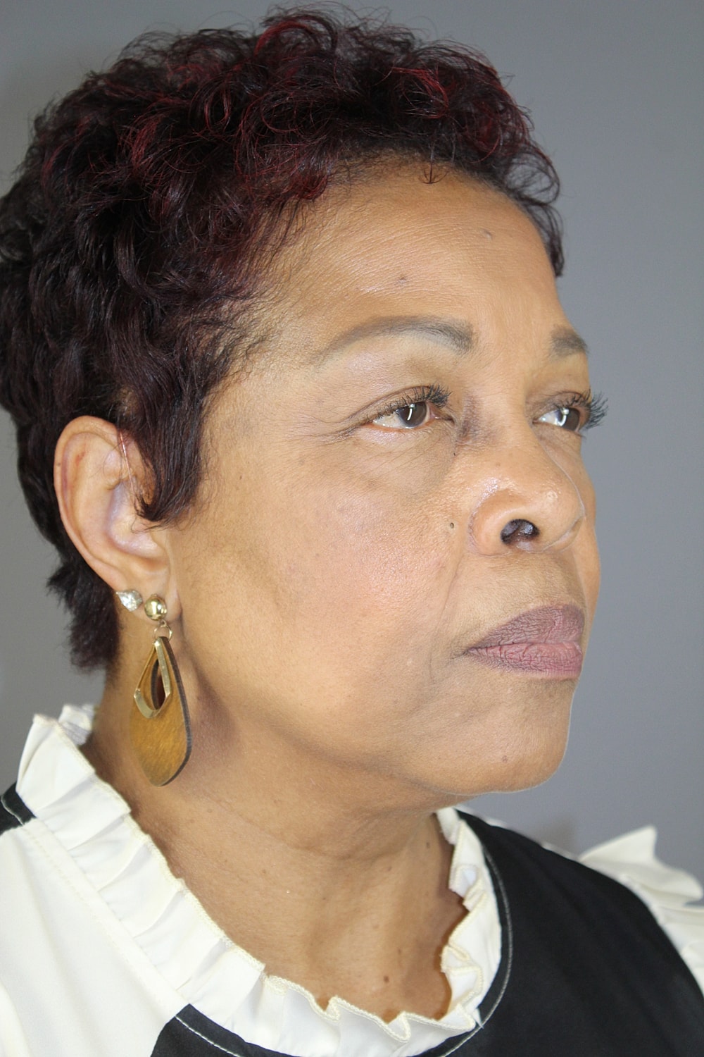 Face Lift Before & After