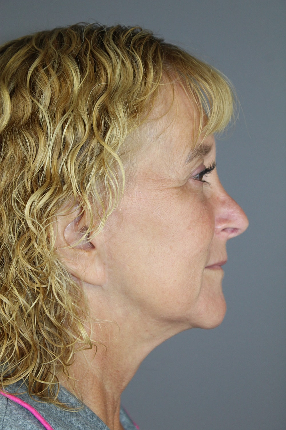 Face Lift Before & After