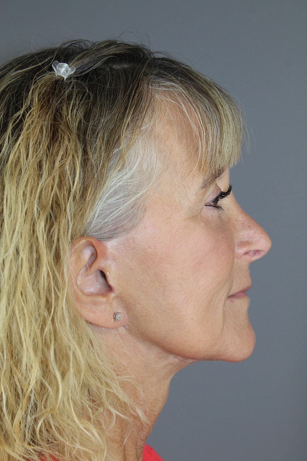 Face Lift Before & After