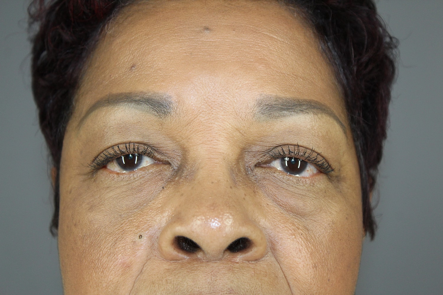 Face Lift Before & After