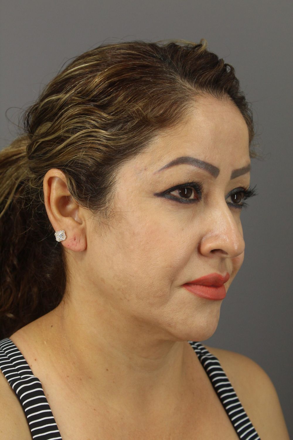 Neck Lift Before & After