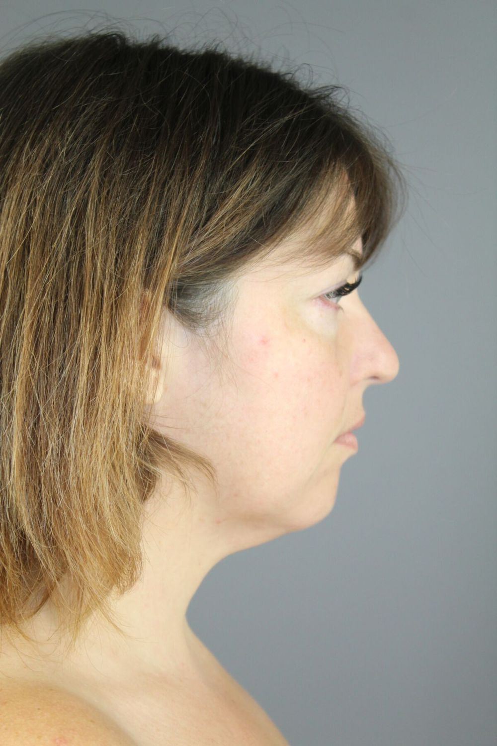 Neck Lift Before & After