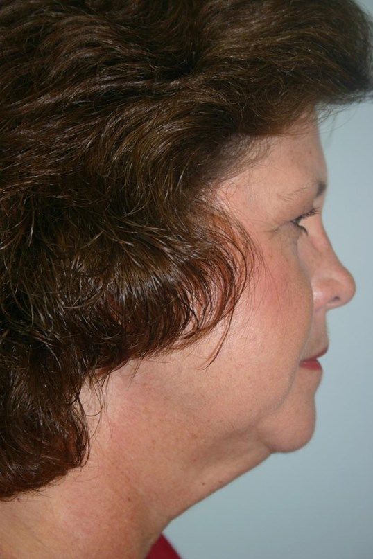 Neck Lift Before & After