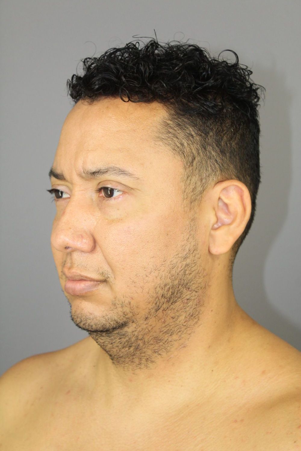 Neck Lift Before & After