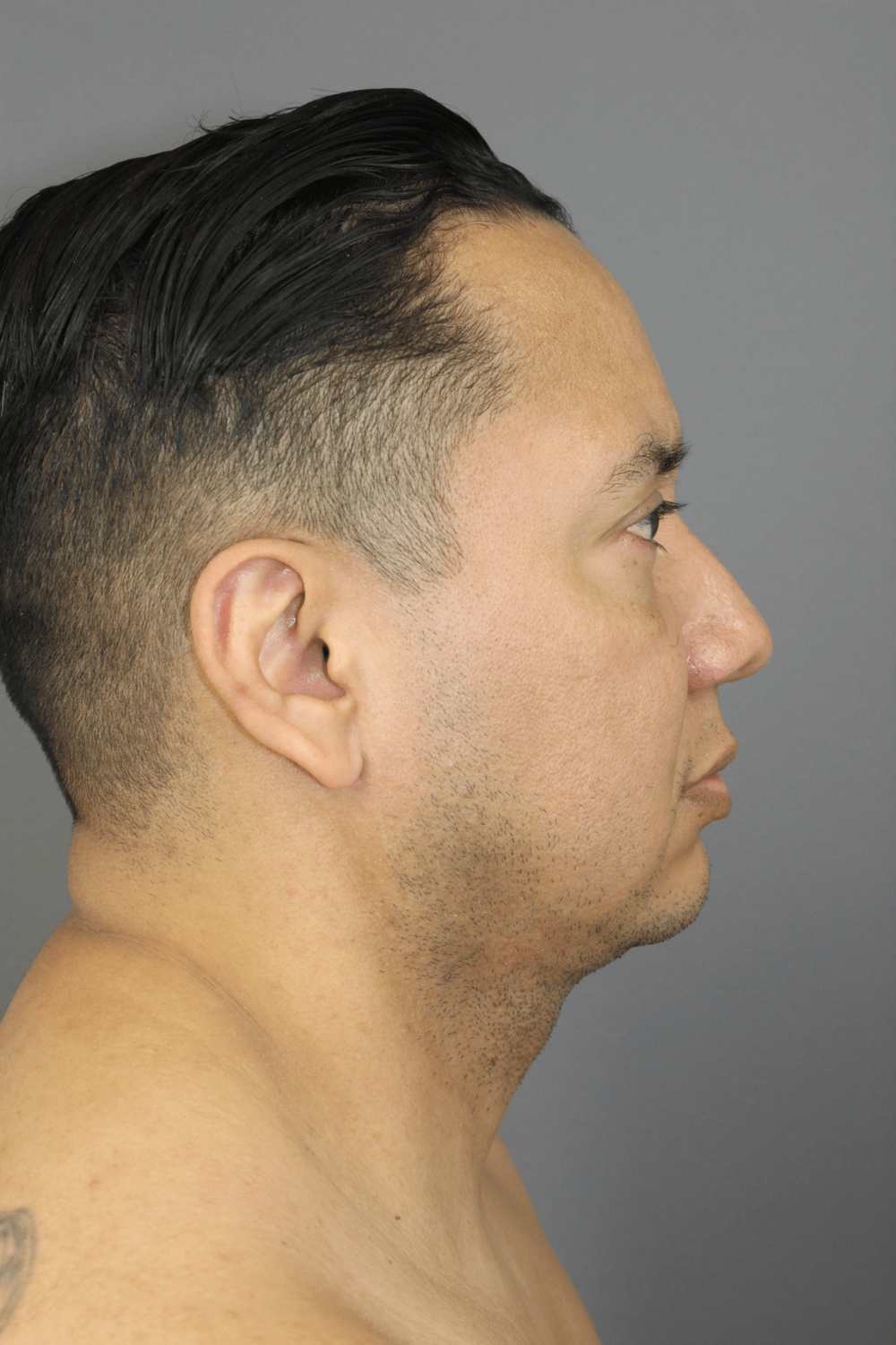 Neck Lift Before & After