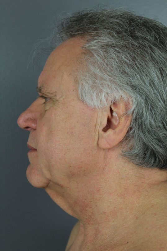 Neck Lift Before & After