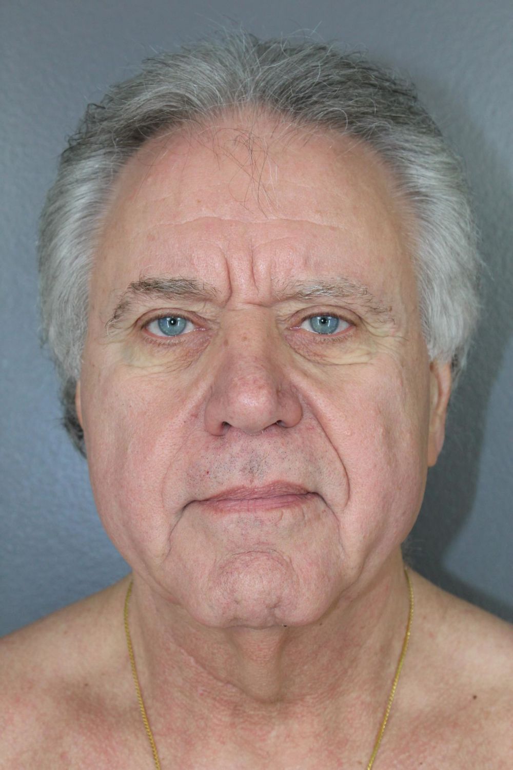 Neck Lift Before & After