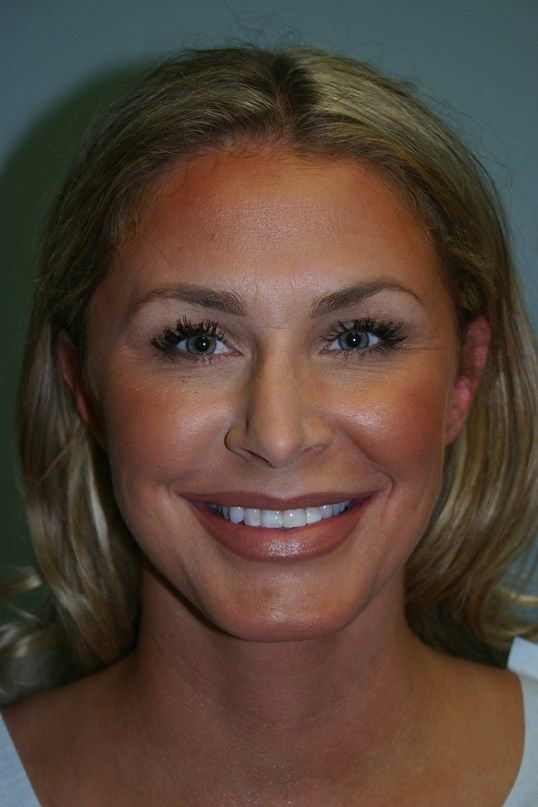 Neck Lift Before & After