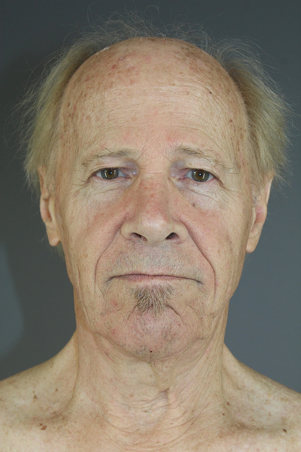 Neck Lift Before & After