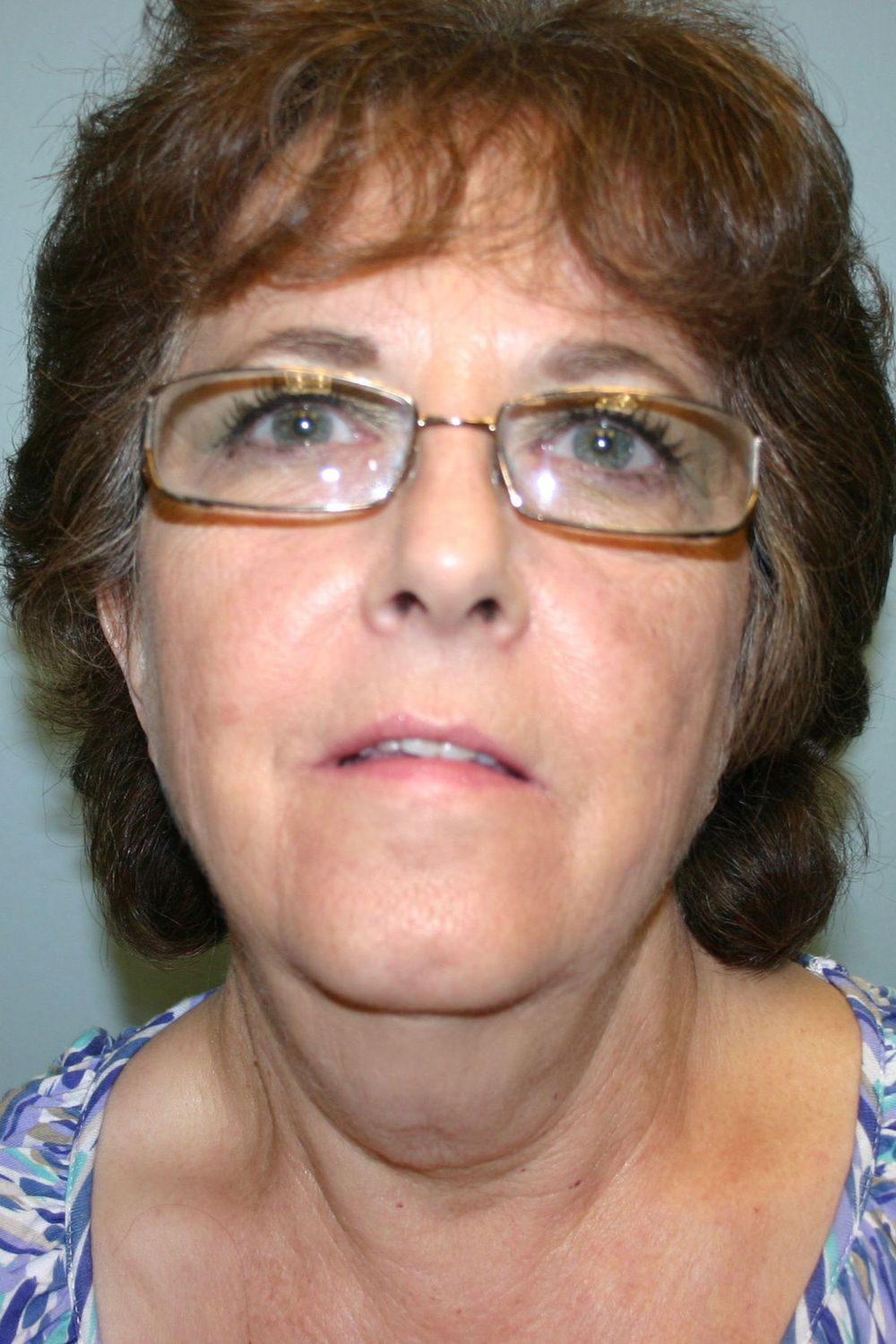 Neck Lift Before & After