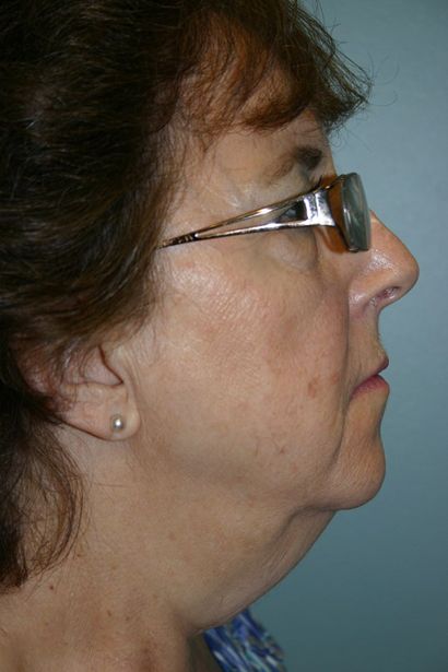 Neck Lift Before & After