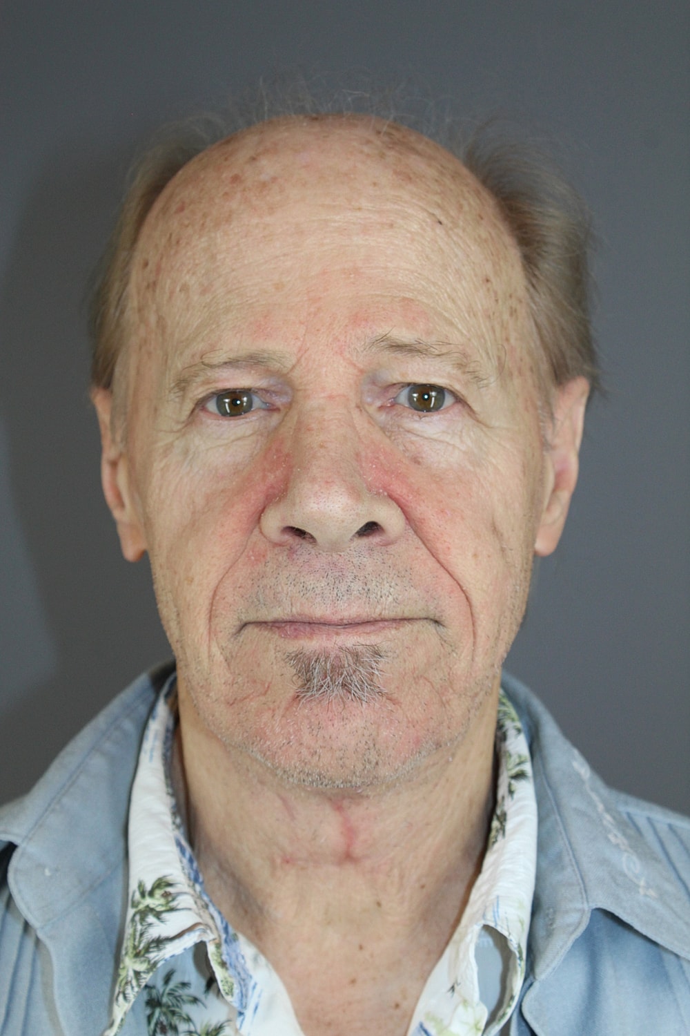 Neck Lift Before & After