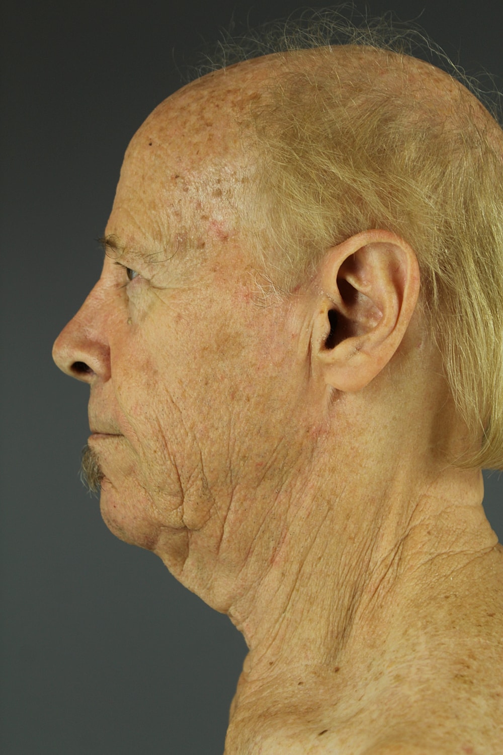 Neck Lift Before & After