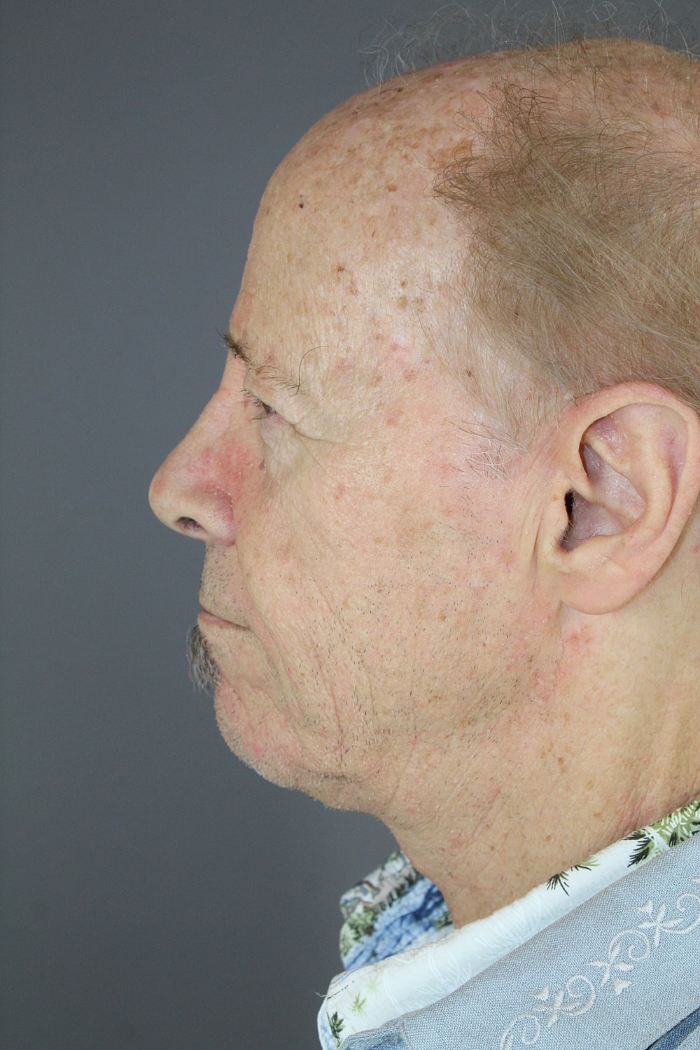 Neck Lift Before & After