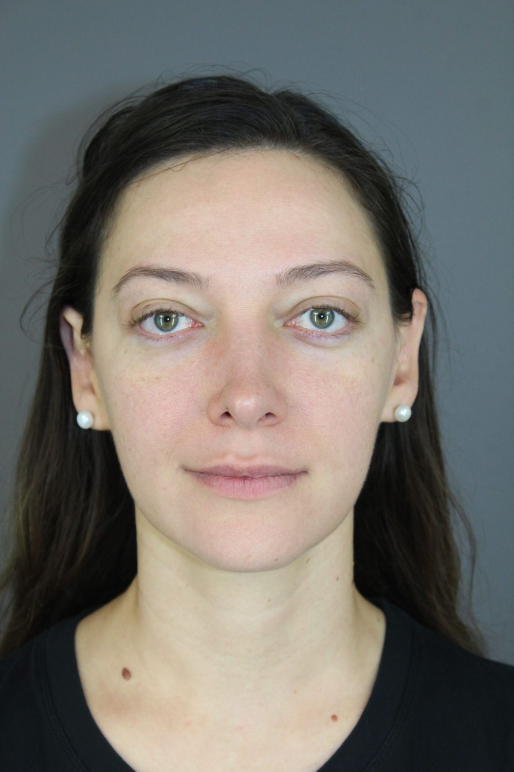 Ear Surgery Before & After