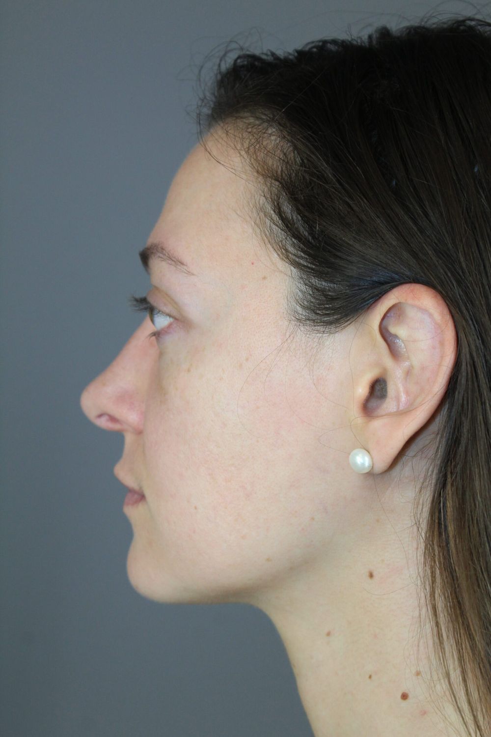 Ear Surgery Before & After