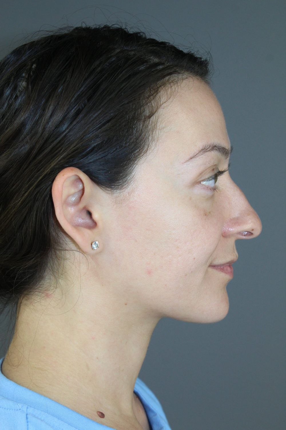 Ear Surgery Before & After