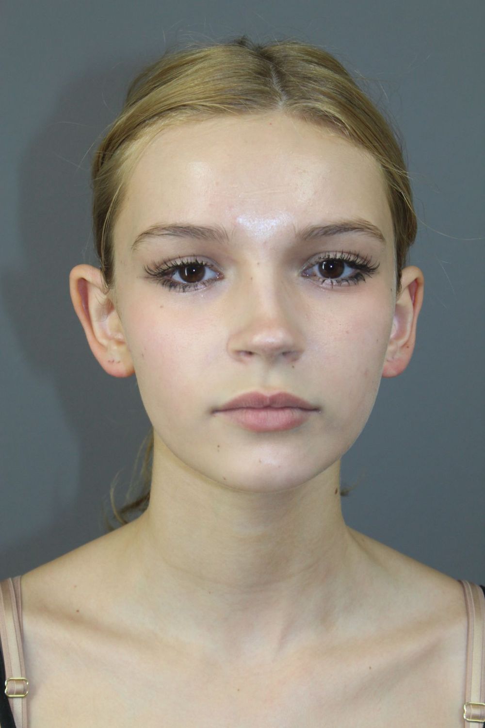 Ear Surgery Before & After