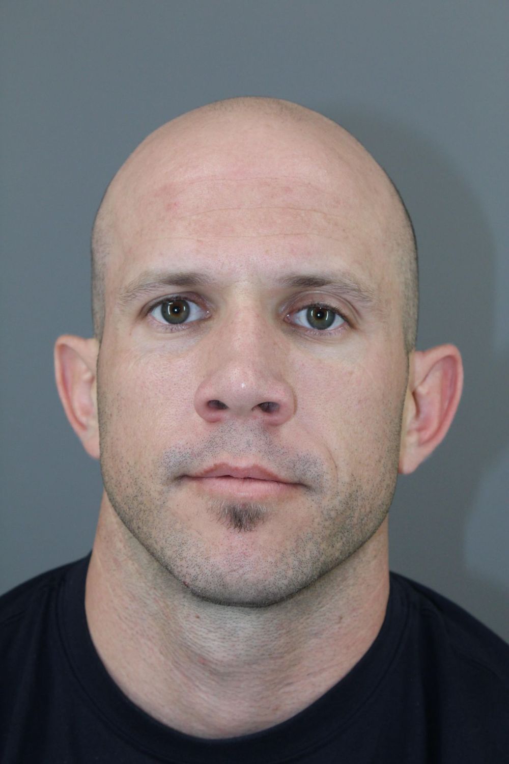 Ear Surgery Before & After