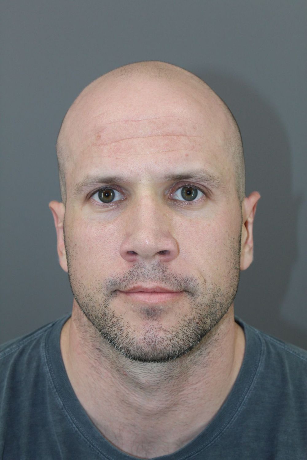 Ear Surgery Before & After