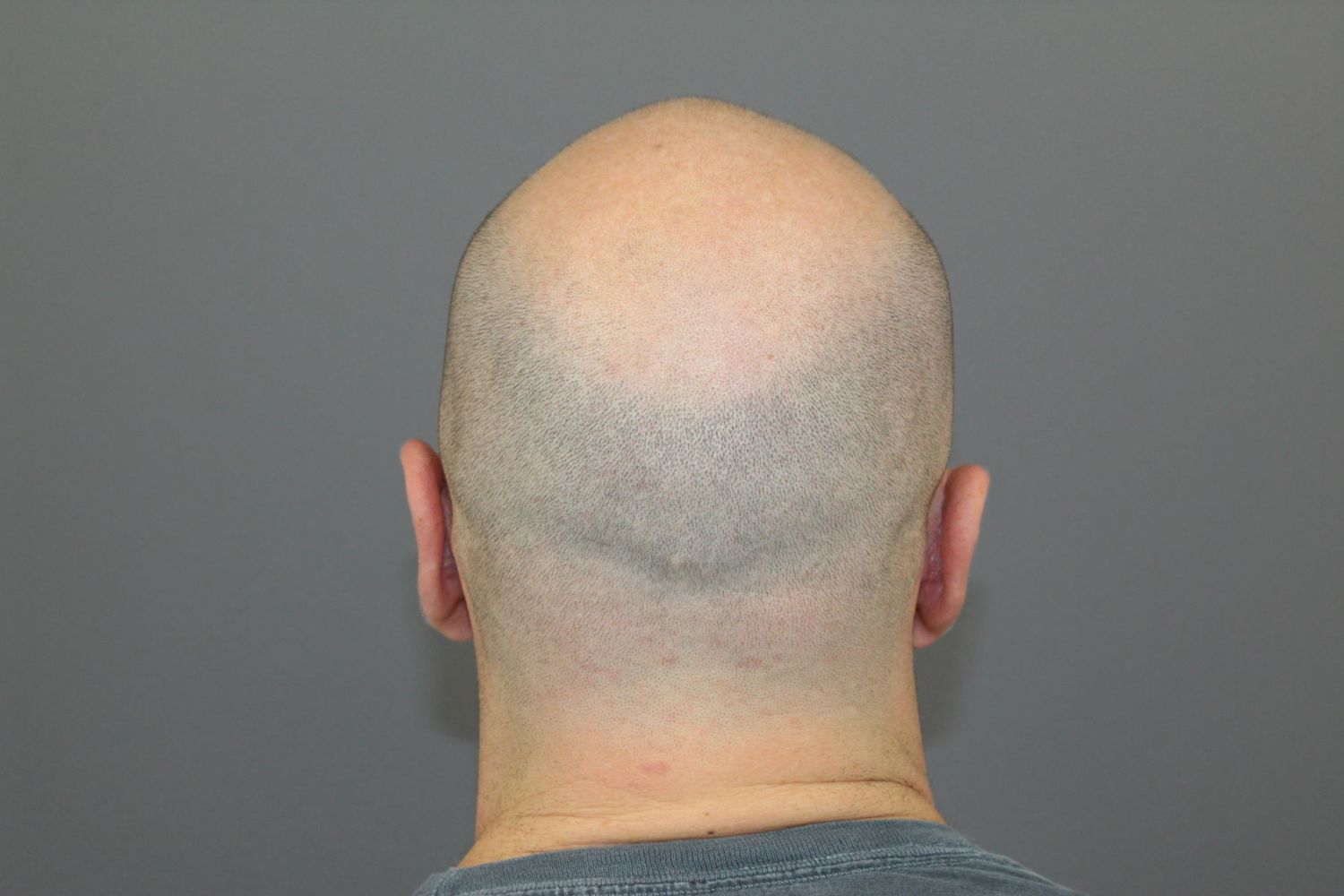 Ear Surgery Before & After