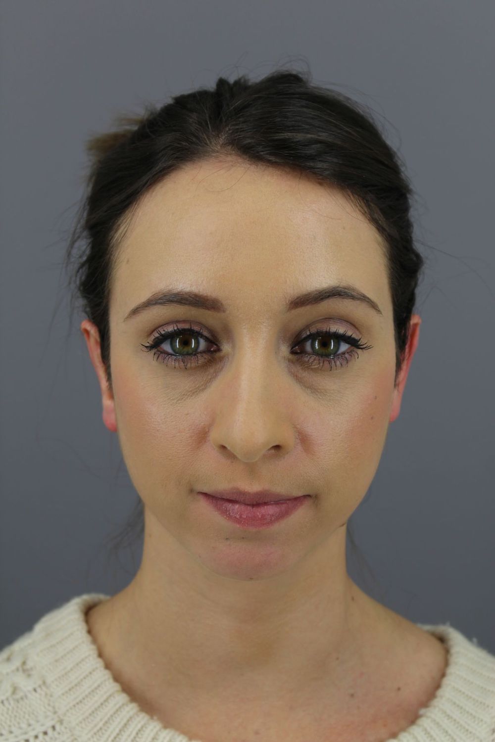 Ear Surgery Before & After