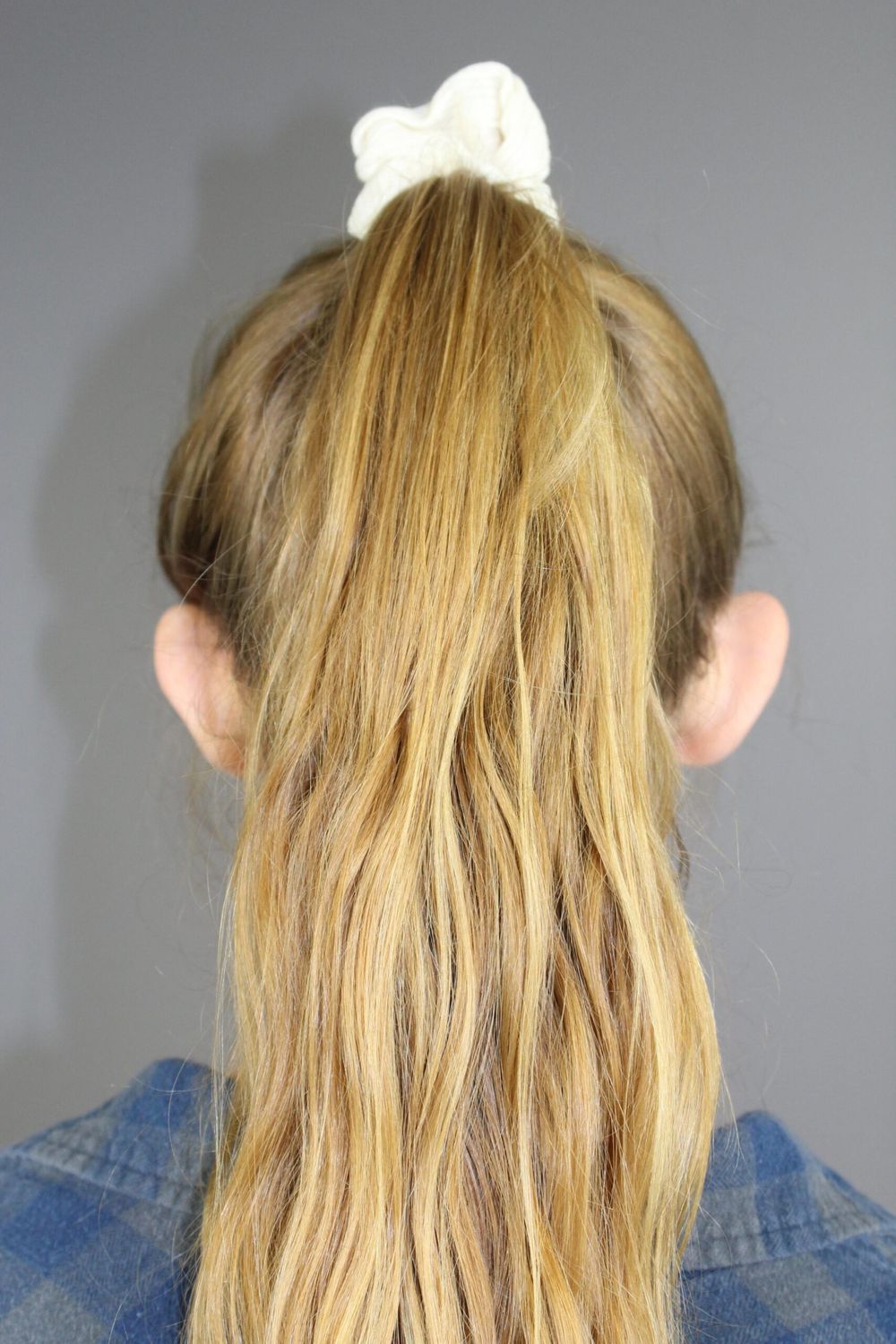 Ear Surgery Before & After