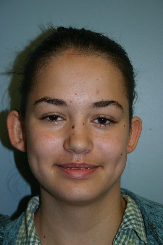 Ear Surgery Before & After