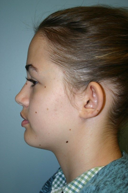 Ear Surgery Before & After